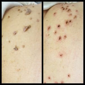 Skin Tags_Easy-Resize.com